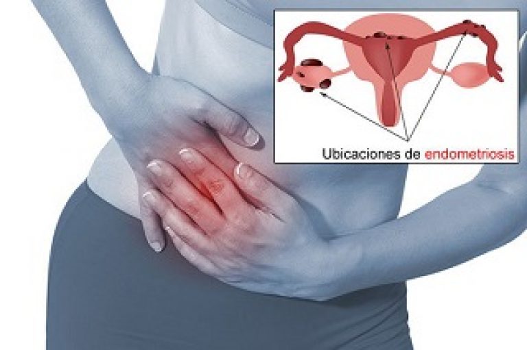 Marzo El Mes De La Endometriosis Síntomas Causas Y Tratamientos 0529